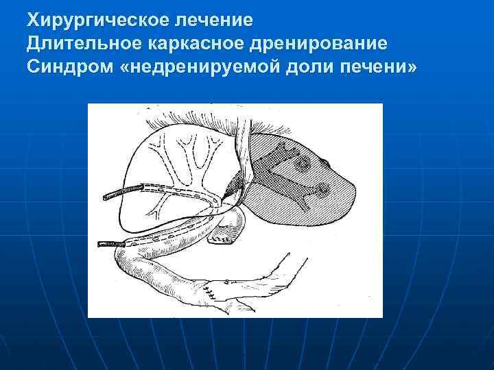 Хирургическое лечение Длительное каркасное дренирование Синдром «недренируемой доли печени» 