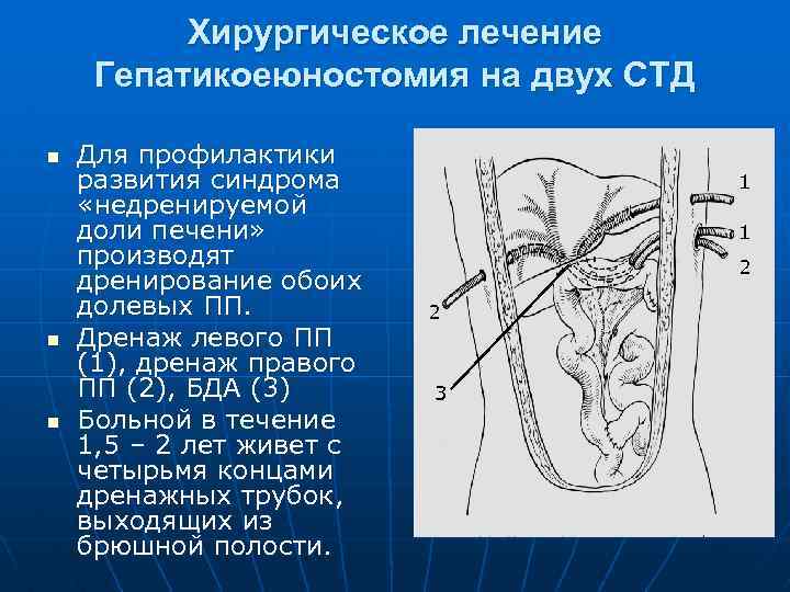 Хирургическое лечение Гепатикоеюностомия на двух СТД n n n Для профилактики развития синдрома «недренируемой