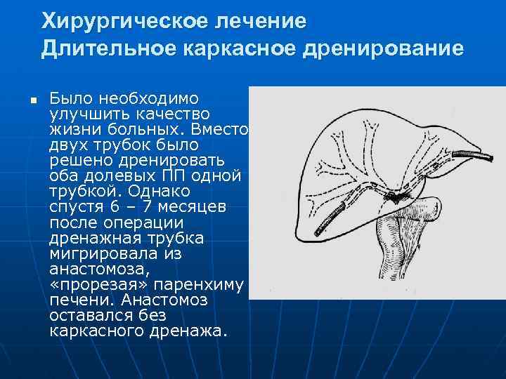 Хирургическое лечение Длительное каркасное дренирование n Было необходимо улучшить качество жизни больных. Вместо двух