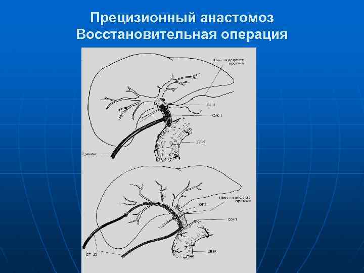 Прецизионный анастомоз Восстановительная операция 