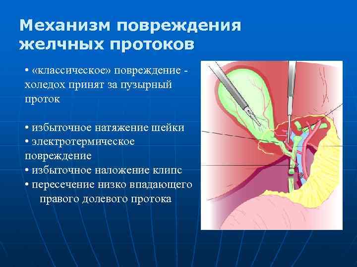 Механизм повреждения желчных протоков • «классическое» повреждение холедох принят за пузырный проток • избыточное