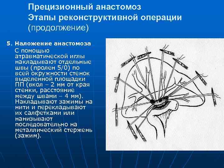 Прецизионный анастомоз Этапы реконструктивной операции (продолжение) 5. Наложение анастомоза С помощью атравматической иглы накладывают