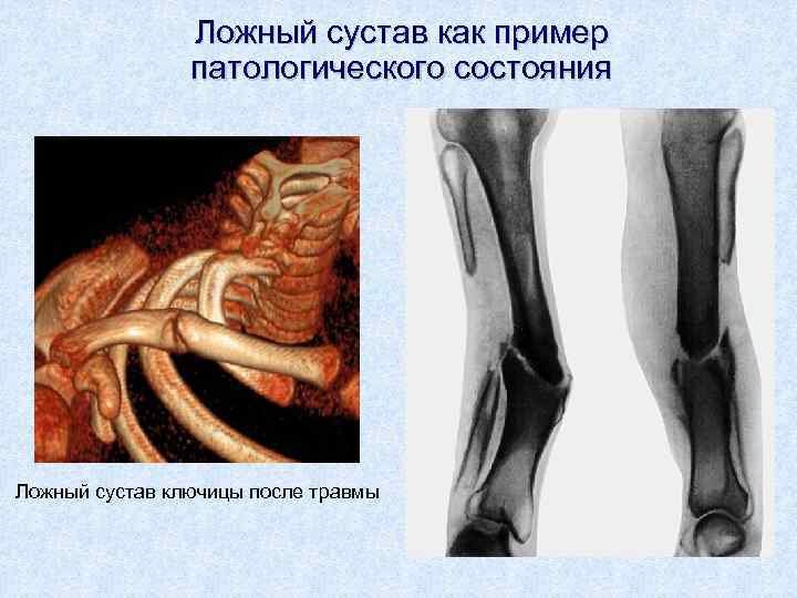 Ложный сустав как пример патологического состояния Ложный сустав ключицы после травмы 