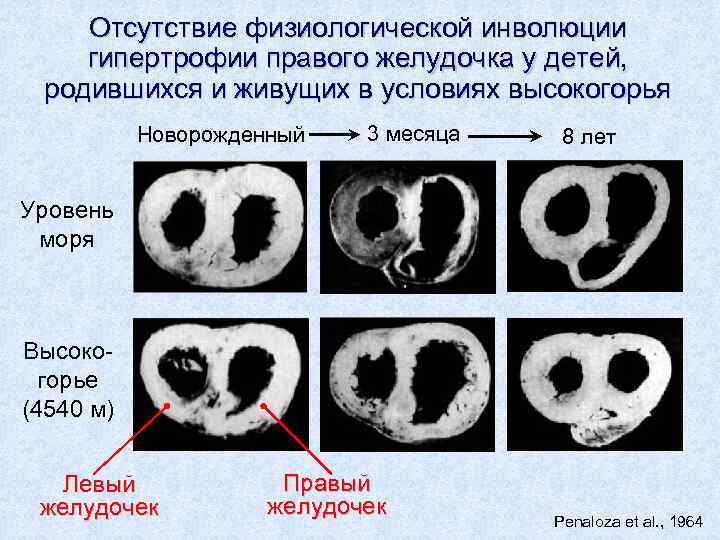 Отсутствие физиологической инволюции гипертрофии правого желудочка у детей, родившихся и живущих в условиях высокогорья