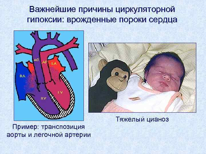 Важнейшие причины циркуляторной гипоксии: врожденные пороки сердца Пример: транспозиция аорты и легочной артерии Тяжелый