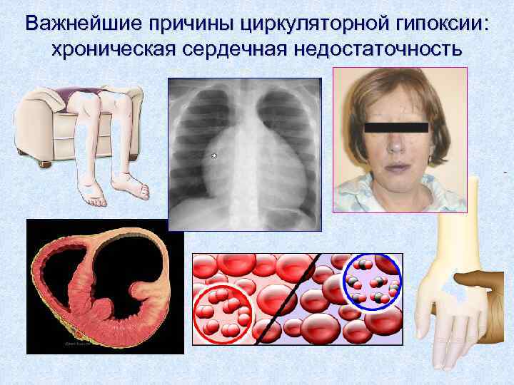 Важнейшие причины циркуляторной гипоксии: хроническая сердечная недостаточность 