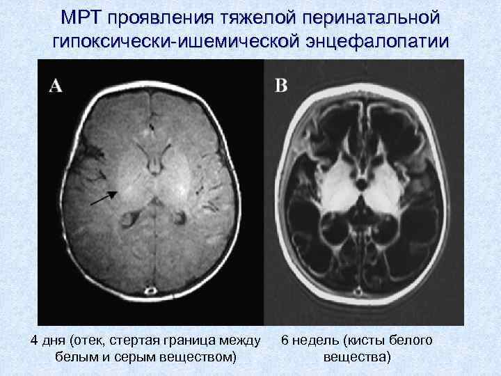 МРТ проявления тяжелой перинатальной гипоксически-ишемической энцефалопатии 4 дня (отек, стертая граница между белым и