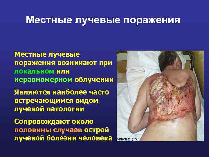 Местные лучевые поражения возникают при локальном или неравномерном облучении Являются наиболее часто встречающимся видом