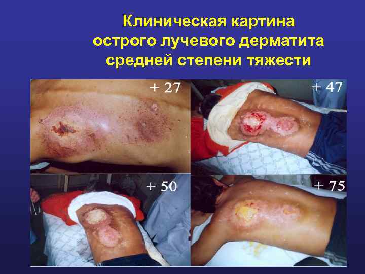 Клиническая картина острого лучевого дерматита средней степени тяжести 