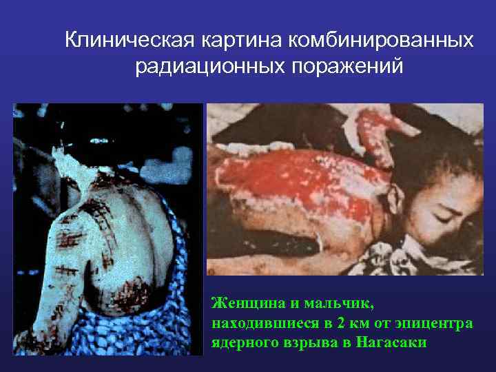 Клиническая картина комбинированных радиационных поражений Женщина и мальчик, находившиеся в 2 км от эпицентра