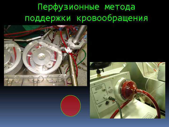 Перфузионные метода поддержки кровообращения 