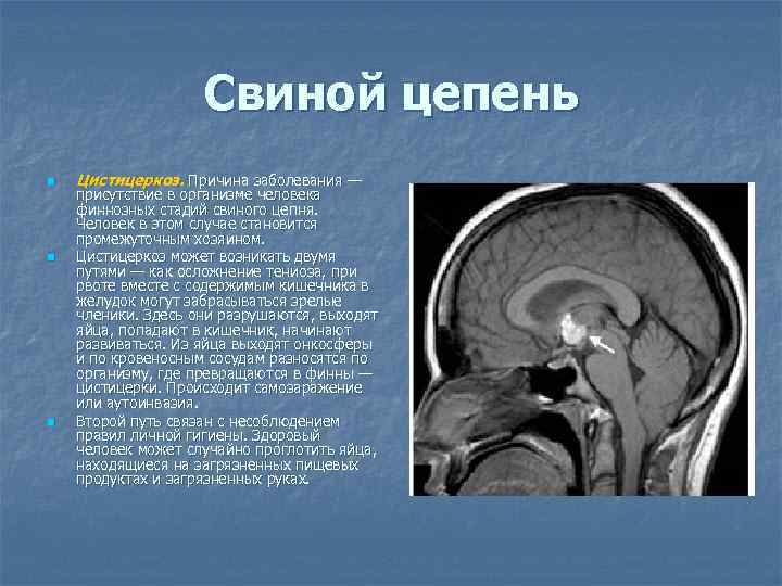 Свиной цепень n n n Цистицеркоз. Причина заболевания — присутствие в организме человека финнозных