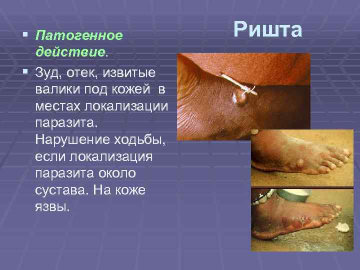 § Патогенное действие. § Зуд, отек, извитые валики под кожей в местах локализации паразита.