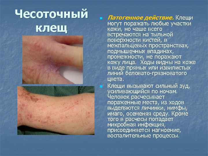 Чесоточный клещ n n Патогенное действие. Клещи могут поражать любые участки кожи, но чаше