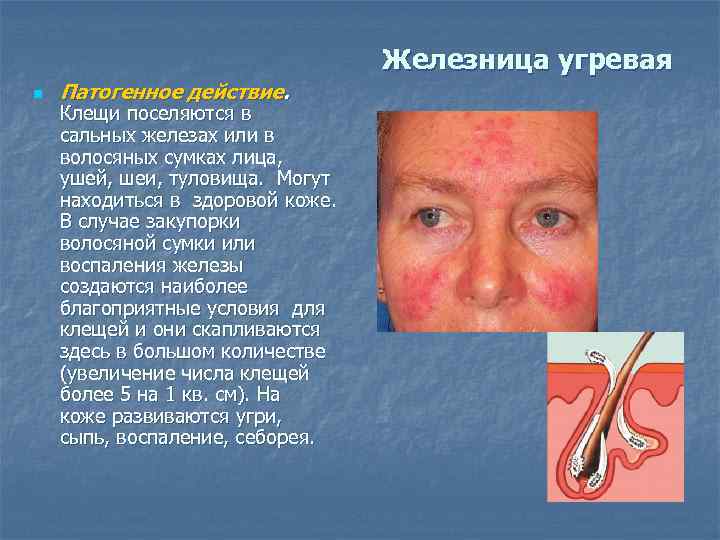 Железница угревая n Патогенное действие. Клещи поселяются в сальных железах или в волосяных сумках