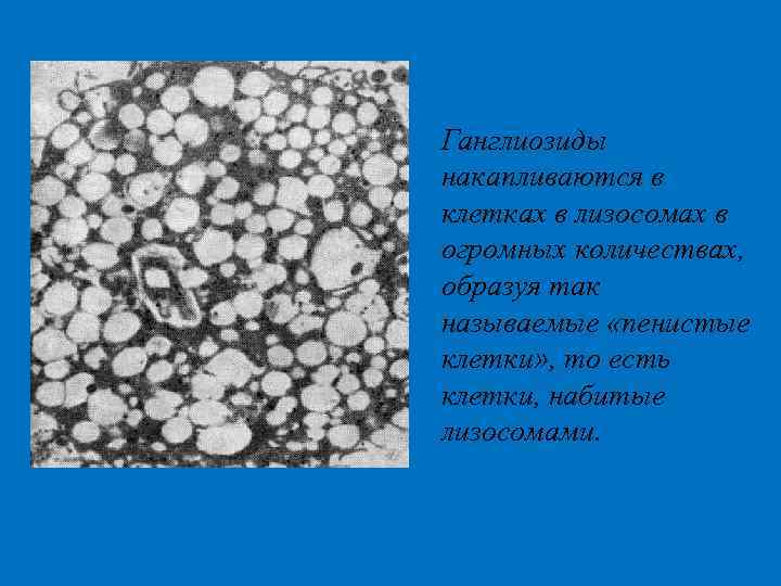 Ганглиозиды накапливаются в клетках в лизосомах в огромных количествах, образуя так называемые «пенистые клетки»