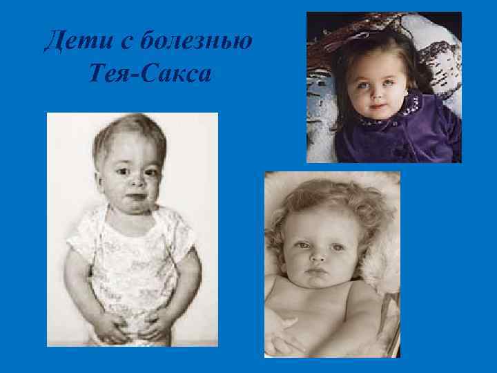 Дети с болезнью Тея-Сакса 