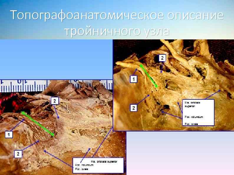 Топографоанатомическое описание тройничного узла 