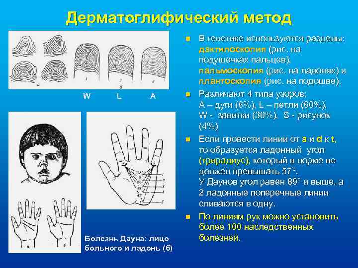 Дерматоглифический метод n W L A n n n Болезнь Дауна: лицо больного и