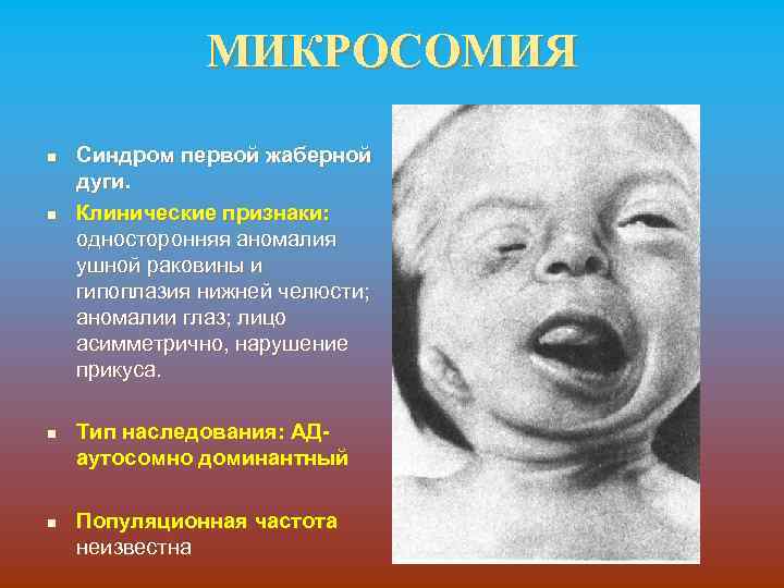МИКРОСОМИЯ n n Синдром первой жаберной дуги. Клинические признаки: односторонняя аномалия ушной раковины и