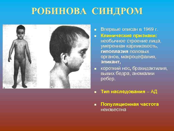 РОБИНОВА СИНДРОМ n n n Впервые описан в 1969 г. Клинические признаки: необычное строение