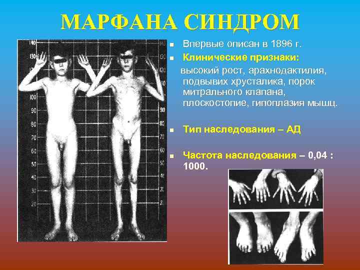 МАРФАНА СИНДРОМ Впервые описан в 1896 г. n Клинические признаки: высокий рост, арахнодактилия, подвывих