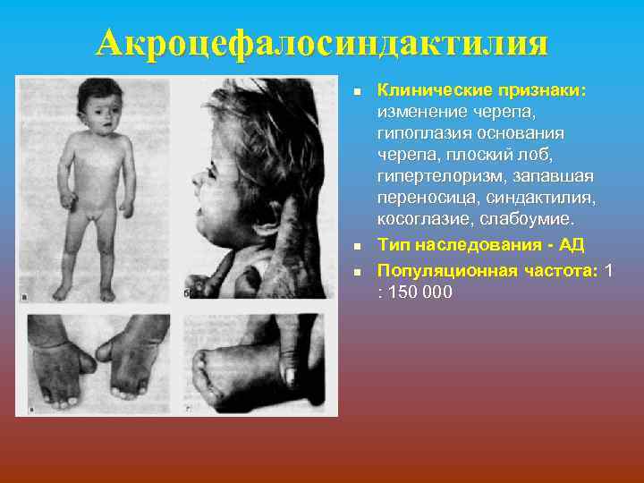 Акроцефалосиндактилия n n n Клинические признаки: изменение черепа, гипоплазия основания черепа, плоский лоб, гипертелоризм,