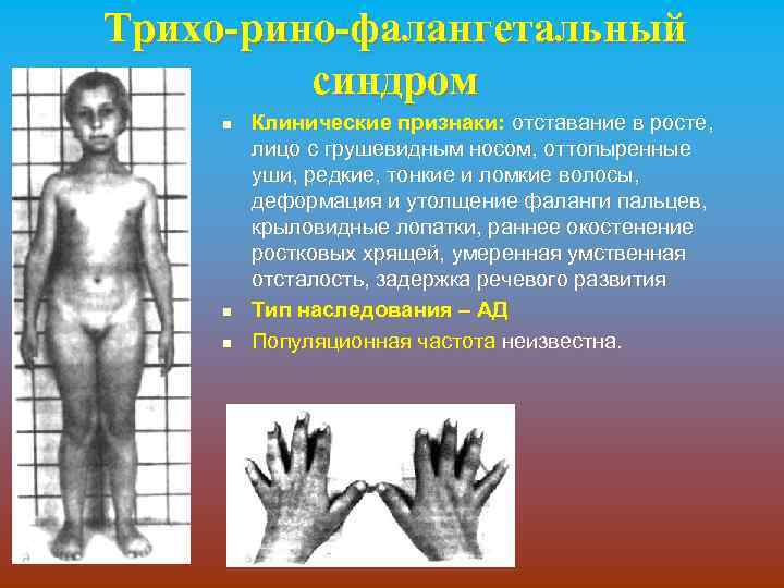 Трихо-рино-фалангетальный синдром n n n Клинические признаки: отставание в росте, лицо с грушевидным носом,