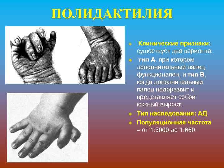 ПОЛИДАКТИЛИЯ u u Клинические признаки: существует два варианта: тип А, при котором дополнительный палец