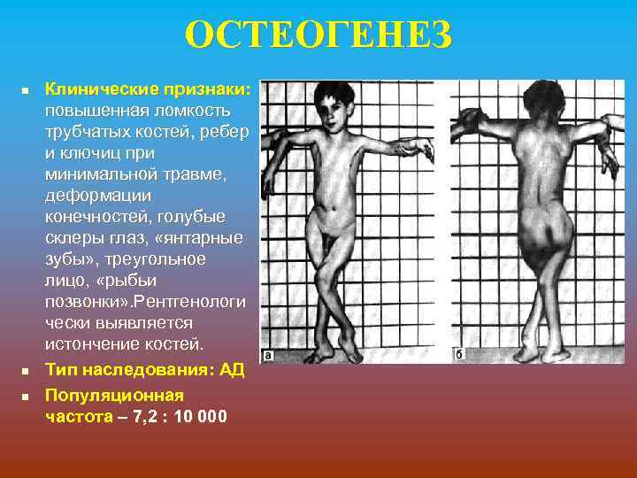 ОСТЕОГЕНЕЗ n n n Клинические признаки: повышенная ломкость трубчатых костей, ребер и ключиц при