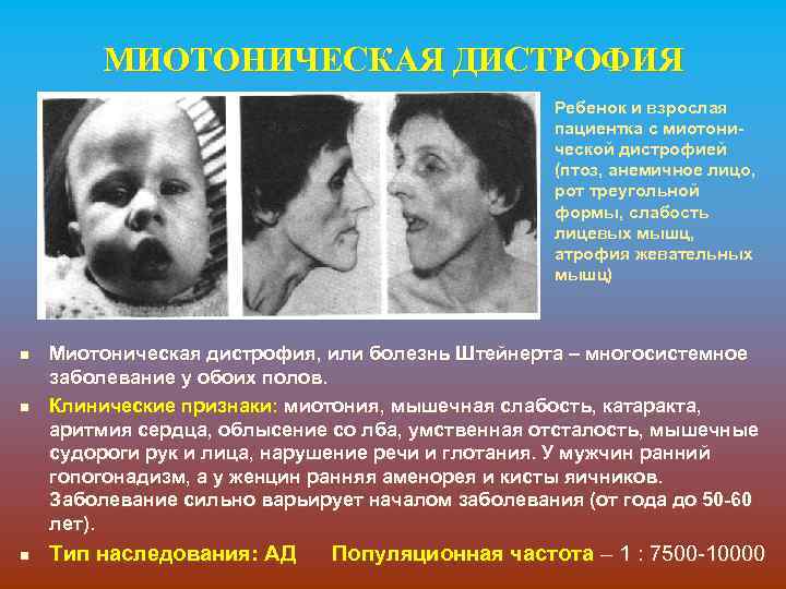 МИОТОНИЧЕСКАЯ ДИСТРОФИЯ Ребенок и взрослая пациентка с миотонической дистрофией (птоз, анемичное лицо, рот треугольной