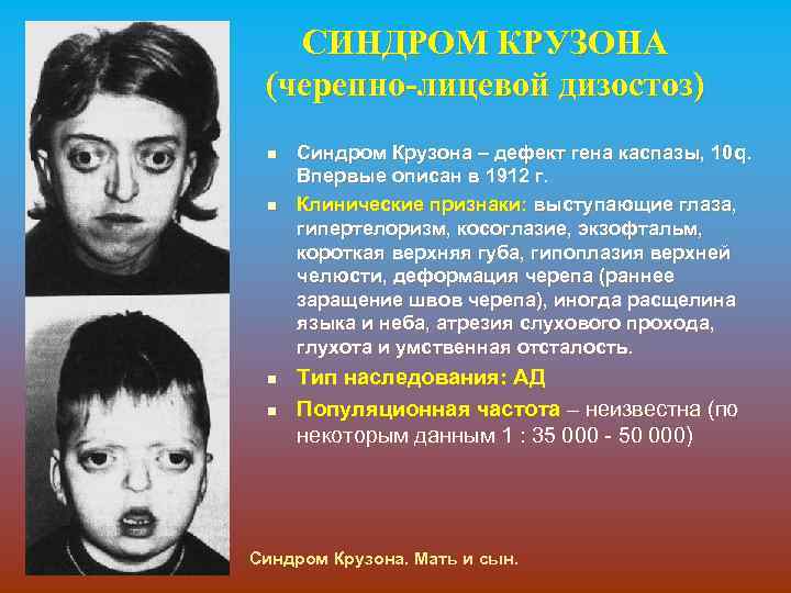 СИНДРОМ КРУЗОНА (черепно-лицевой дизостоз) n n Синдром Крузона – дефект гена каспазы, 10 q.