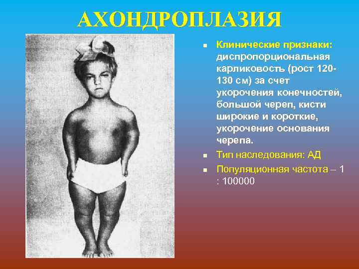 АХОНДРОПЛАЗИЯ n n n Клинические признаки: диспропорциональная карликовость (рост 120130 см) за счет укорочения
