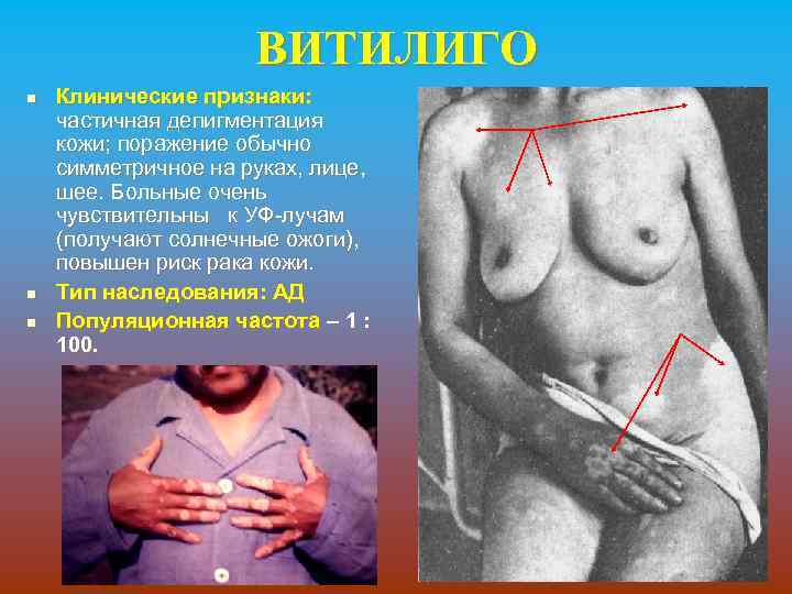 ВИТИЛИГО n n n Клинические признаки: частичная депигментация кожи; поражение обычно симметричное на руках,