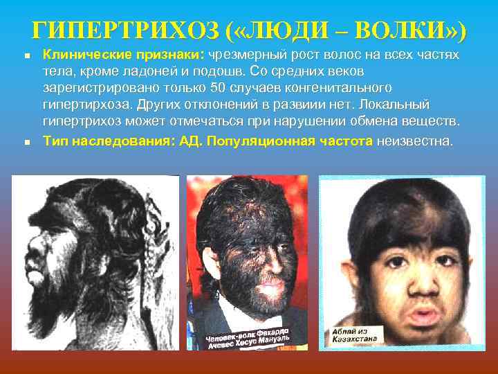 ГИПЕРТРИХОЗ ( «ЛЮДИ – ВОЛКИ» ) n n Клинические признаки: чрезмерный рост волос на