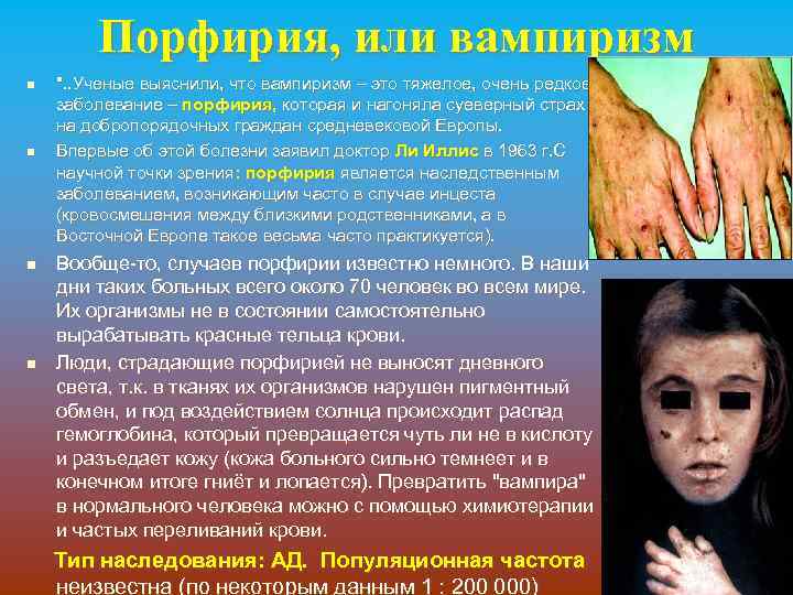 Порфирия, или вампиризм n n ". . Ученые выяснили, что вампиризм – это тяжелое,