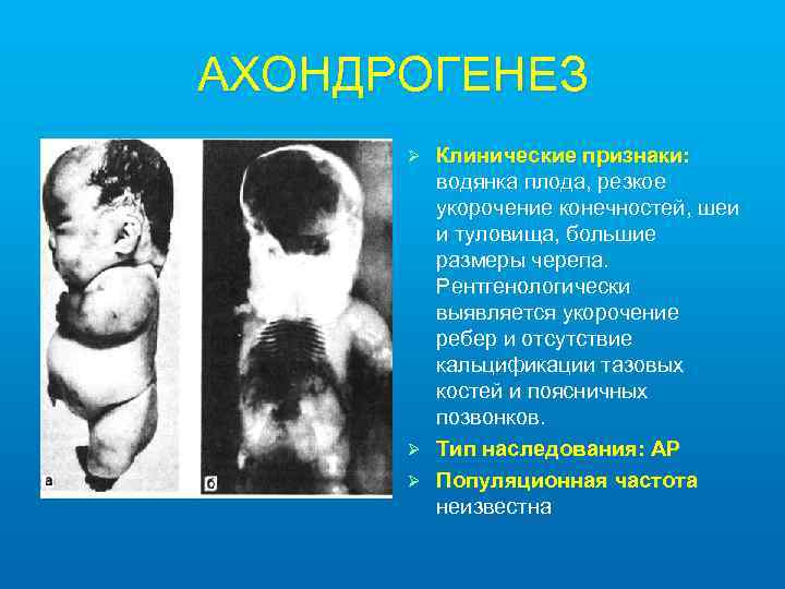 АХОНДРОГЕНЕЗ Клинические признаки: водянка плода, резкое укорочение конечностей, шеи и туловища, большие размеры черепа.