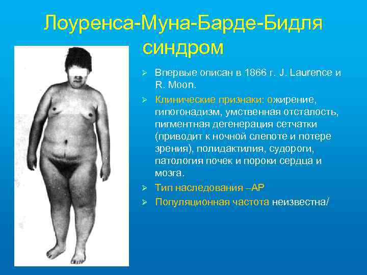 Лоуренса-Муна-Барде-Бидля синдром Ø Ø Впервые описан в 1866 г. J. Laurence и R. Moon.