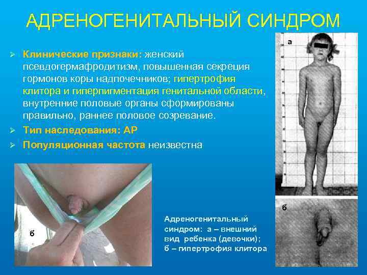 АДРЕНОГЕНИТАЛЬНЫЙ СИНДРОМ а Клинические признаки: женский псевдогермафродитизм, повышенная секреция гормонов коры надпочечников; гипертрофия клитора