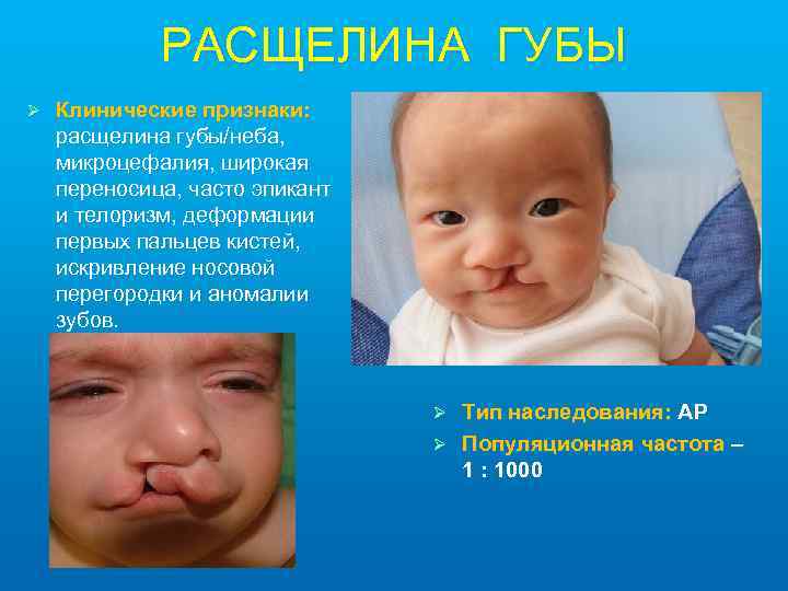 РАСЩЕЛИНА ГУБЫ Ø Клинические признаки: расщелина губы/неба, микроцефалия, широкая переносица, часто эпикант и телоризм,