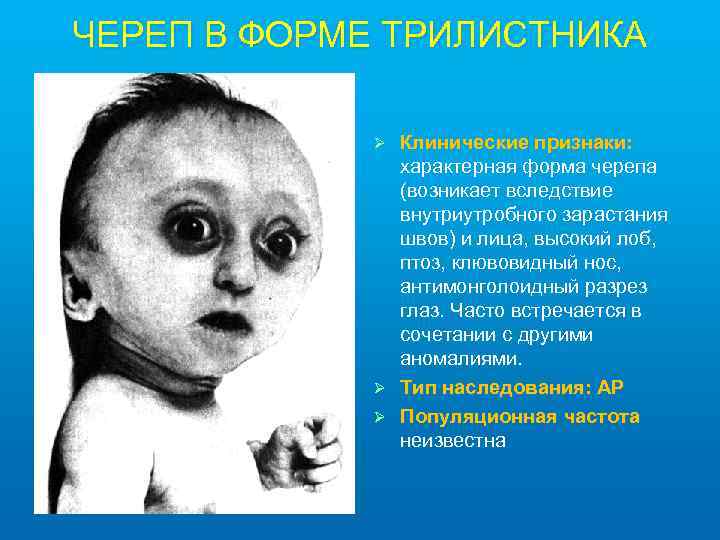 ЧЕРЕП В ФОРМЕ ТРИЛИСТНИКА Клинические признаки: характерная форма черепа (возникает вследствие внутриутробного зарастания швов)