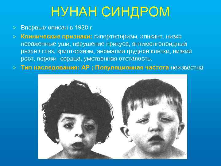 НУНАН СИНДРОМ Впервые описан в 1928 г. Ø Клинические признаки: гипертелоризм, эпикант, низко посаженные