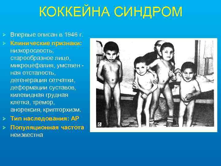 КОККЕЙНА СИНДРОМ Ø Ø Впервые описан в 1946 г. Клинические признаки: низкорослость, старообразное лицо,