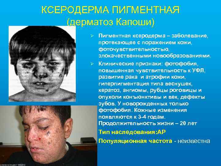 КСЕРОДЕРМА ПИГМЕНТНАЯ (дерматоз Капоши) Пигментная ксеродерма – заболевание, протекающее с поражением кожи, фоточувствительностью, злокачественными