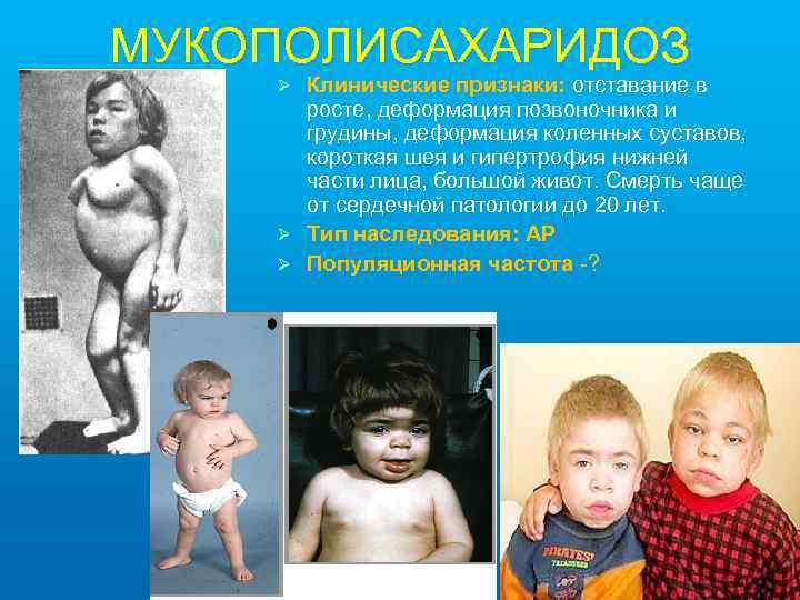МУКОПОЛИСАХАРИДОЗ Клинические признаки: отставание в росте, деформация позвоночника и грудины, деформация коленных суставов, короткая