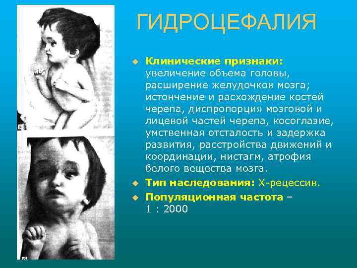 ГИДРОЦЕФАЛИЯ u u u Клинические признаки: увеличение объема головы, расширение желудочков мозга; истончение и