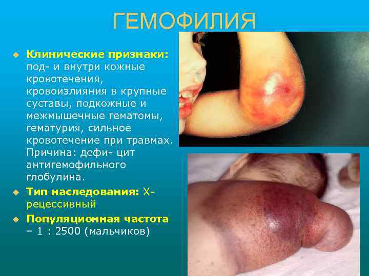 ГЕМОФИЛИЯ u u u Клинические признаки: под- и внутри кожные кровотечения, кровоизлияния в крупные