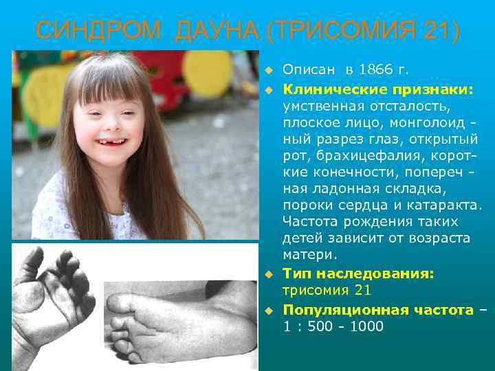 СИНДРОМ ДАУНА (ТРИСОМИЯ 21) u u Описан в 1866 г. Клинические признаки: умственная отсталость,