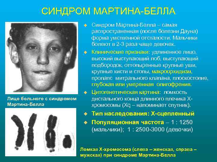СИНДРОМ МАРТИНА-БЕЛЛА u u u Лицо больного с синдромом Мартина-Белла u u Синдром Мартина-Белла