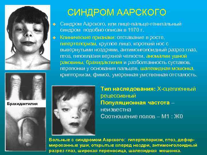 СИНДРОМ ААРСКОГО u u Брахидактилия Синдром Аарского, или лице-пальце-генитальный синдром подобно описан в 1970